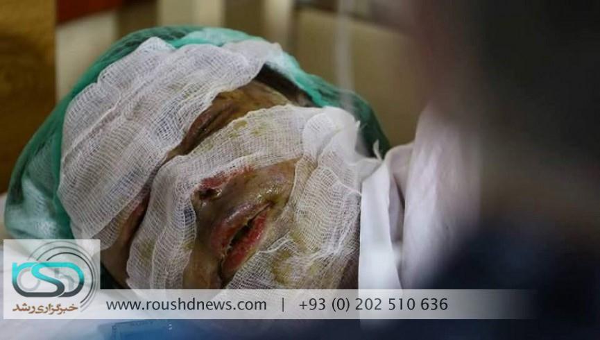 تصویر از افراد ناشناس برصورت یک سرمعلم زن در هرات اسید پاشید